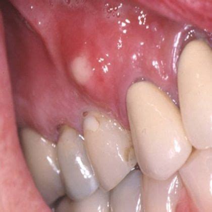 What is phoenix dental abscess? | News | Dentagama