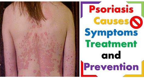 What is Psoriasis causes Symptoms treatment and prevention ...