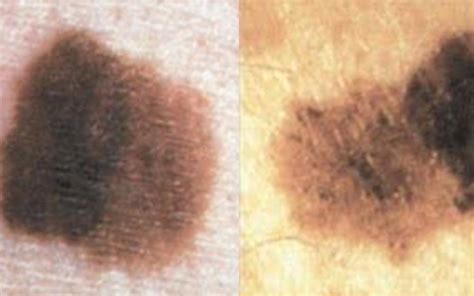 What s the Difference Between Melasma, Sun Spots, and ...