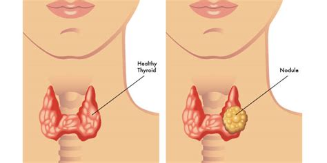 What to do for thyroid nodules – Liver Doctor