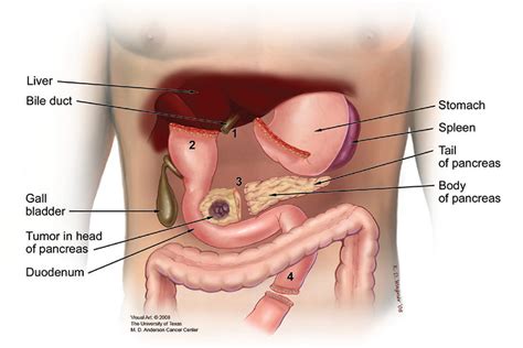 Whipple Procedure  Pancreaticoduodenectomy    Pancreatic ...