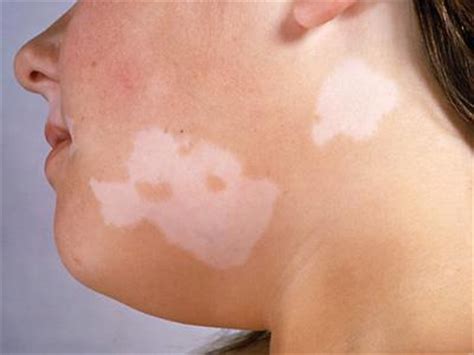White Blotches On Skin  Causes And Treatment? | Fight Vitiligo