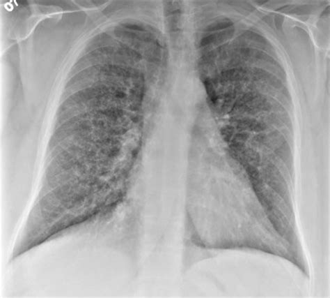 White Patch In Lungs X Rays   pridefiles