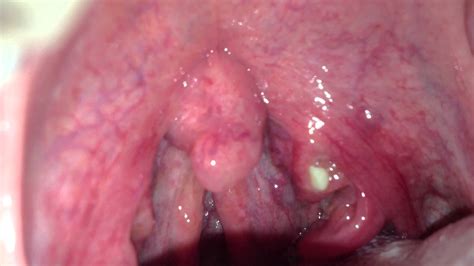 White Spots In The Back Of My Throat   Hardcore Pussy