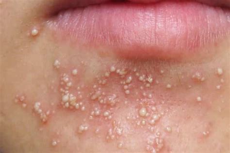 White Spots on Face, Dots, Patches, Small, Pictures ...