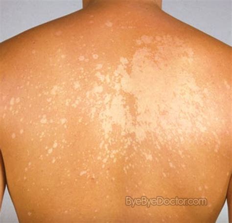 White Spots on Skin #8211; Causes | Symptoms Causes ...