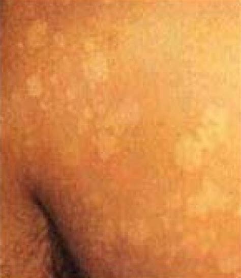 White Spots on Skin   Causes, Pictures, Treatment ...