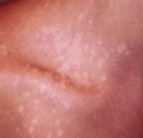 White Spots on Skin   Causes, Pictures, Treatment