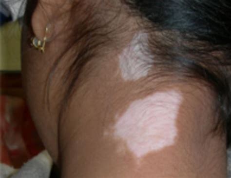 White Spots On Skin Fungus | www.pixshark.com   Images ...