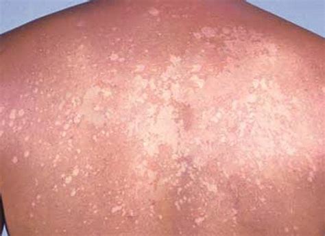 White Spots on Skin   Pictures, Causes, Treatment