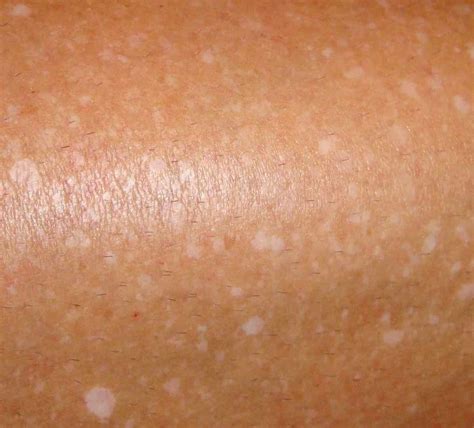 White Spots Skin Cancer | tommycat.info