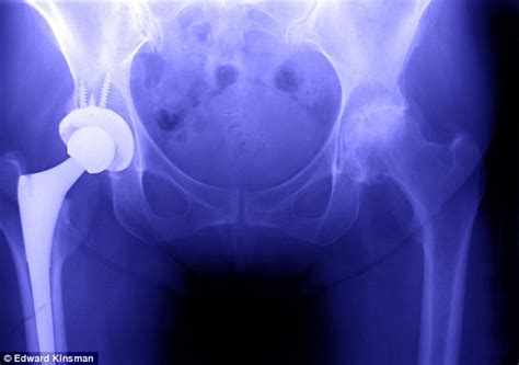 Why a hip replacement can make prostate problems much ...