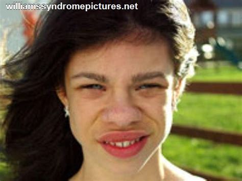 Williams Syndrome Faces