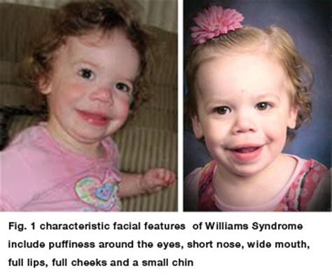 Williams Syndrome — AAPOS