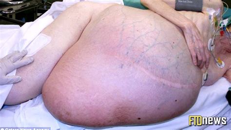 Woman Has 84 Pound Tumor Inside Her Stomach   WNM #64 ...