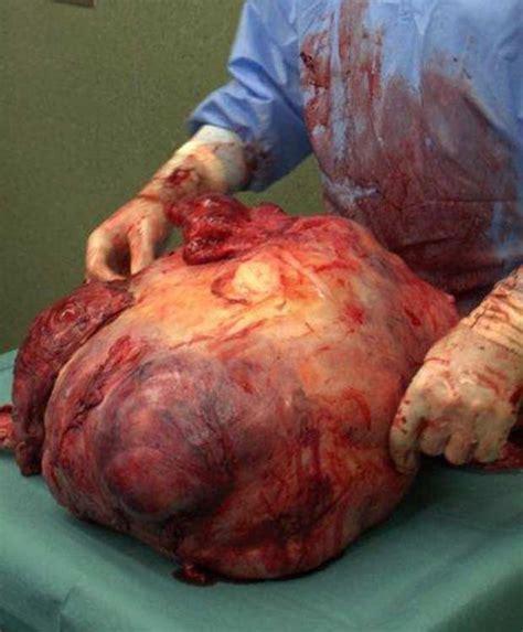 Woman has SIX STONE tumour removed [GRAPHIC CONTENT ...