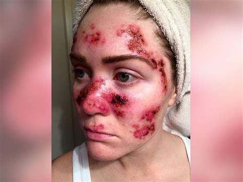 Woman s Skin Cancer Selfie Goes Viral   ABC News