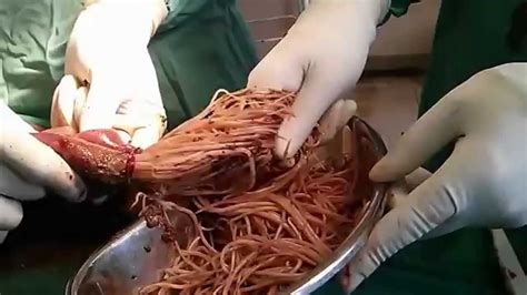 Worm & Parasite Removal from Intestines. NOT for Faint ...