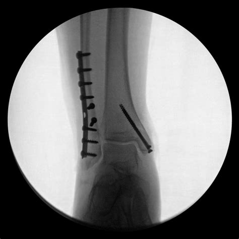 X rays of my broken ankle  September 2006