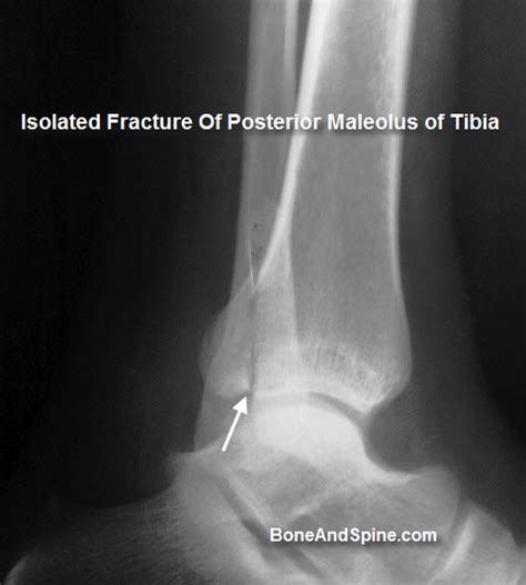 Xray Showing Isolated Fracture of Posterior Malleolus of ...
