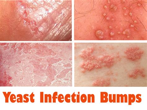 Yeast Infection Bumps: Causes, Symptoms, Remedies and ...
