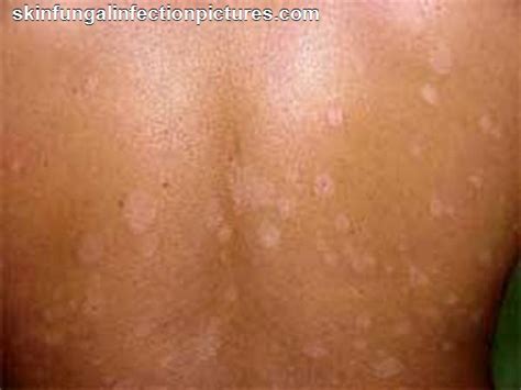 Yeast Infection Skin