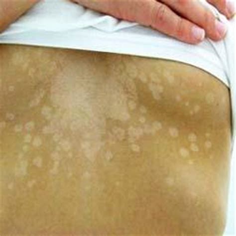 Yeast Infection Skin White Patches Guide